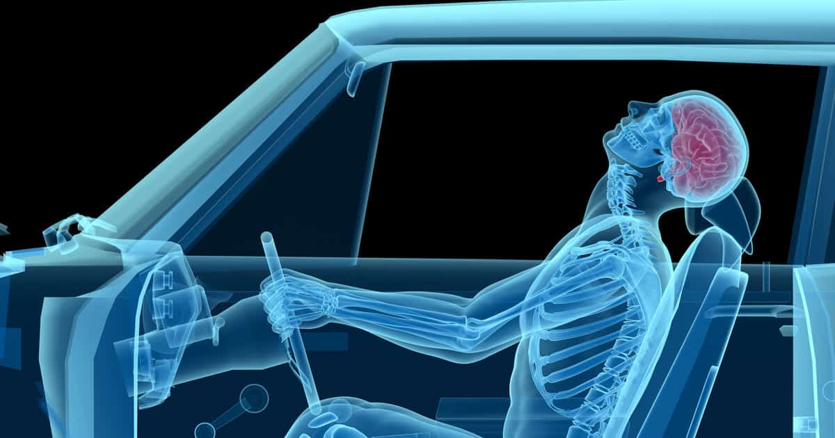 An x-ray image of a person in a car accident shows why it's important to understand the average settlement for car accident back and neck injury cases.